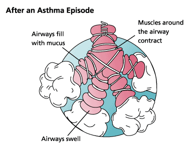 Illustration of an area of the lung after an asthma episode as the airways swell and fill with mucus. 